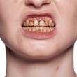 Émail pour dents ivory